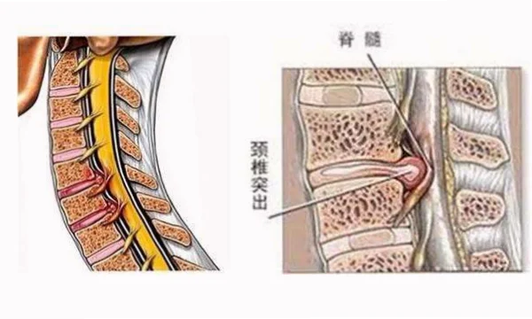 颈椎间盘突出：入水时头部受力不均，易引发神经压迫。